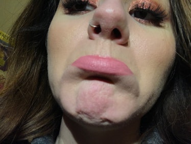 Writer Kimberly Carpluk showing beard burn on her sensitive skin after kissing