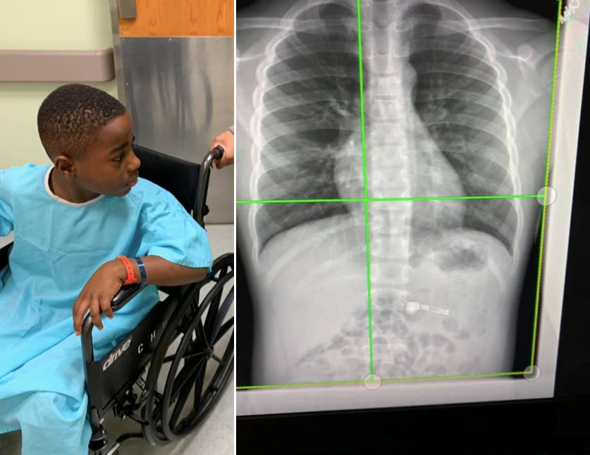 Mom's Story About 7YearOld Swallowing AirPod Serves As A Cautionary Tale