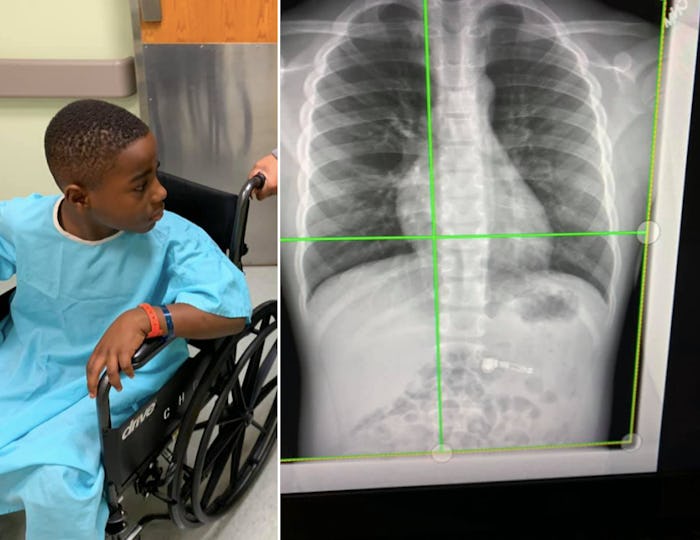 A mom is sharing her story of her 7-year-old son swallowing his AirPods.