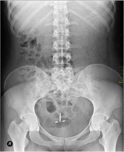 An X-ray showing an IUD inserted into the cervix. 