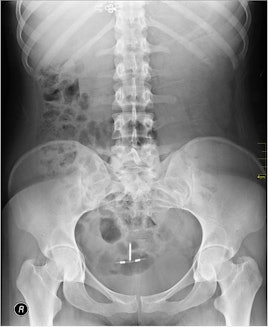 An X-ray showing an IUD inserted into the cervix. 