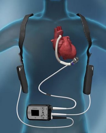 An Abbott HeartMate 3, a type of VAD.