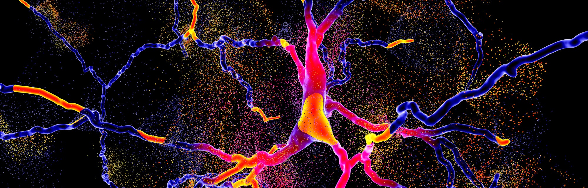 neuron degeneration in parkinson's disease