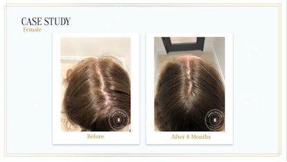 Before and after 8 months of Harklinikken's Customized Hair Treatment