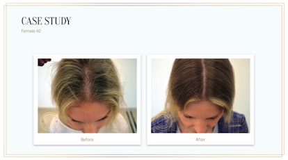 Before and after Harklinikken's Customized Hair Treatment