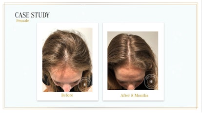 Before and after 8 months of Harklinikken's Customized Hair Treatment