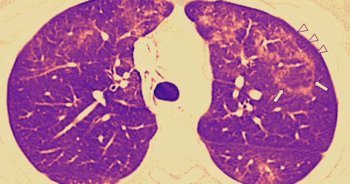 EVALI: 3 shocking images reveal the damage vaping can do to teen lungs