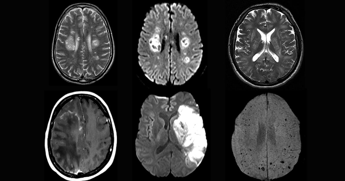 Covid-19 brain: How the virus can wreak havoc on the nervous system