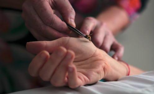 A practitioner guides a bee to sting a woman's hand. Apitherapy, or bee venom therapy, is one of the...