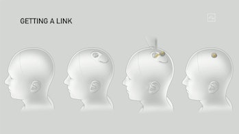 A diagram of a Neuralink being implanted