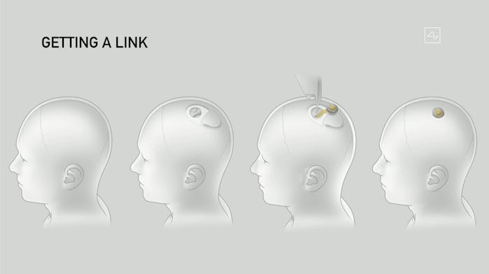 A diagram of a Neuralink being implanted