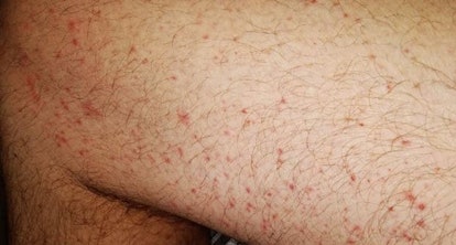 These maculopapular eruptions are associated with more severe disease.