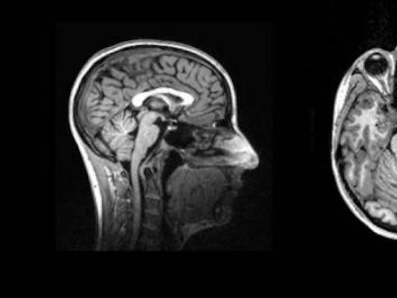 Three brain scans that reveal a link between binge drinking and lack of empathy