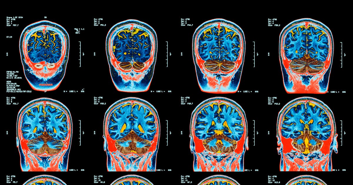 Brain scans reveal a critical link between binge drinking and empathy