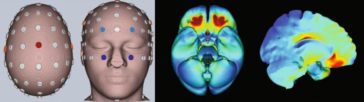 brain stimulation ocd