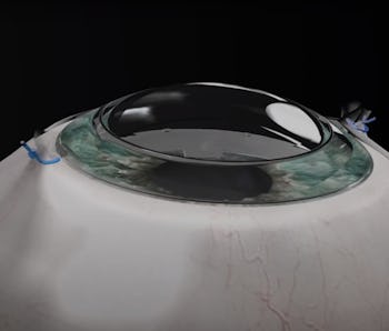 A legally blind 78-year-old regained his sight using a synthetic cornea.