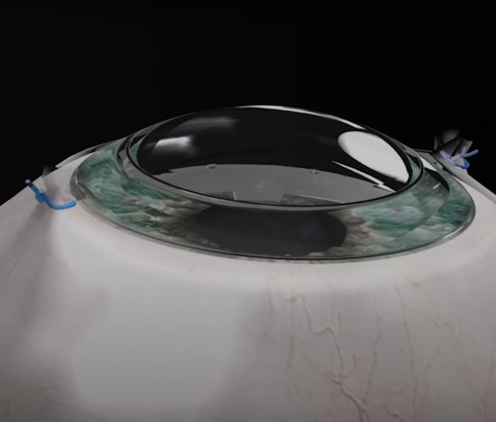 A legally blind 78-year-old regained his sight using a synthetic cornea.