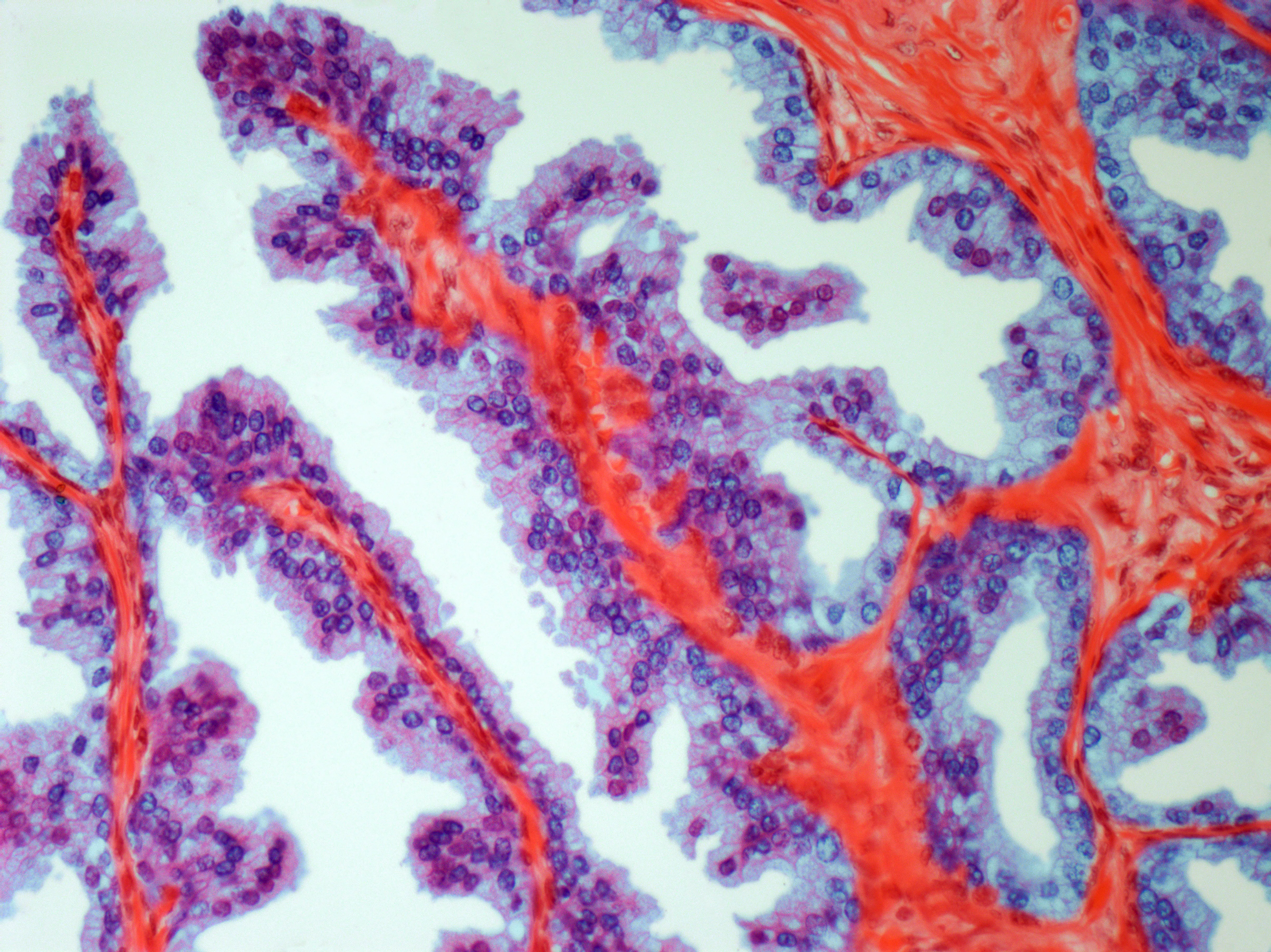 Scientists identify a complex link between gut bacteria and prostate cancer