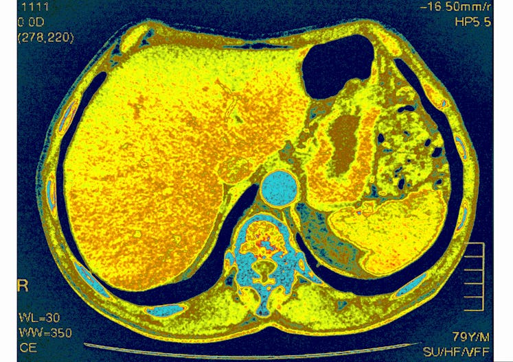A CT scan of the gut