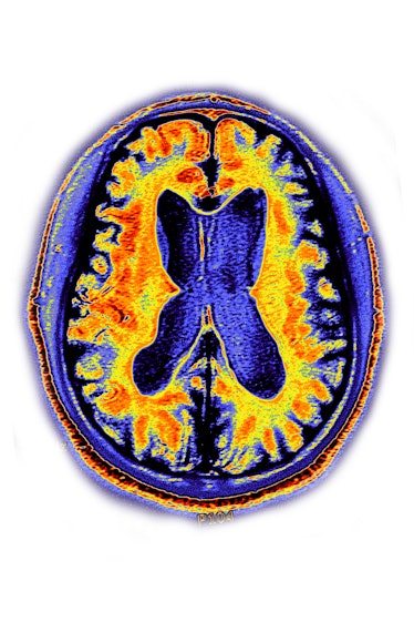 Alzheimer's disease, brain