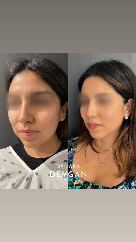 patient before and after of buccal fat removal