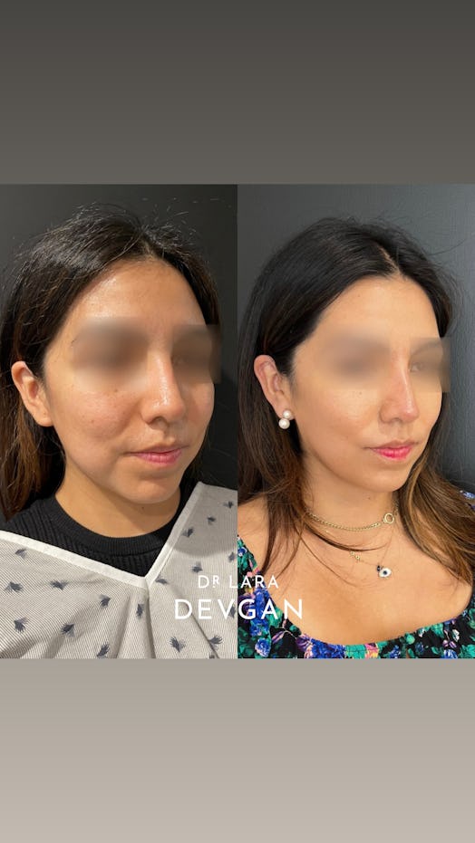 patient before and after of buccal fat removal