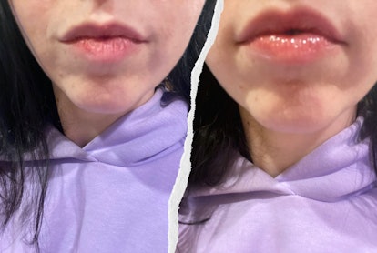 Before and after using the Macrene Actives Lip Filler.