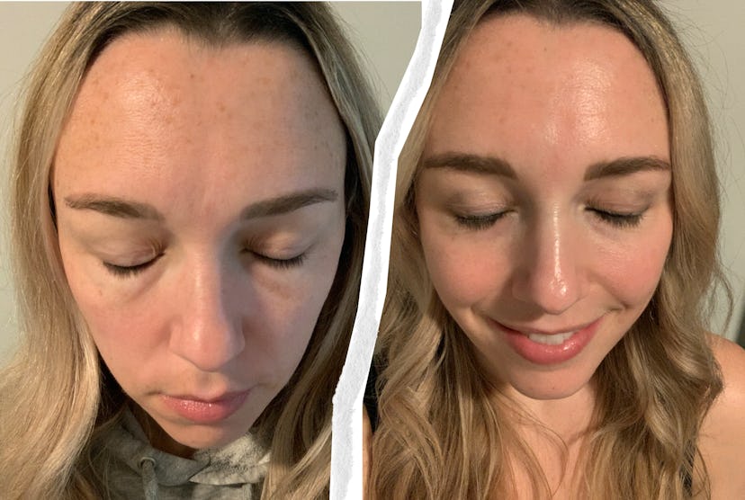 Before and after the Vivace RF Microneedling treatment.