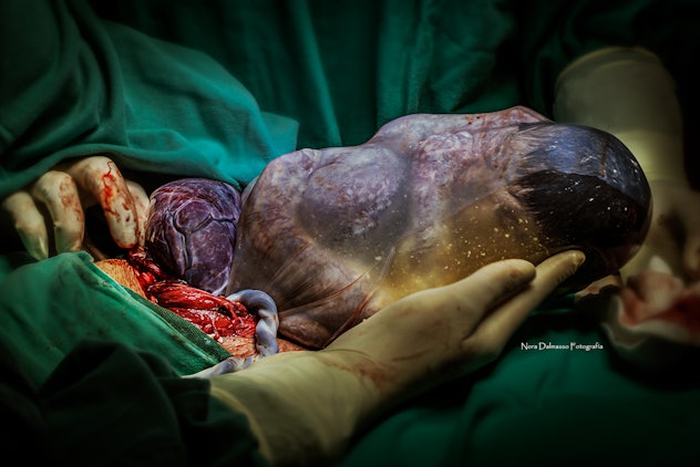 A baby is removed from his mother by gloved hands while still encased in its amniotic sac during a c...