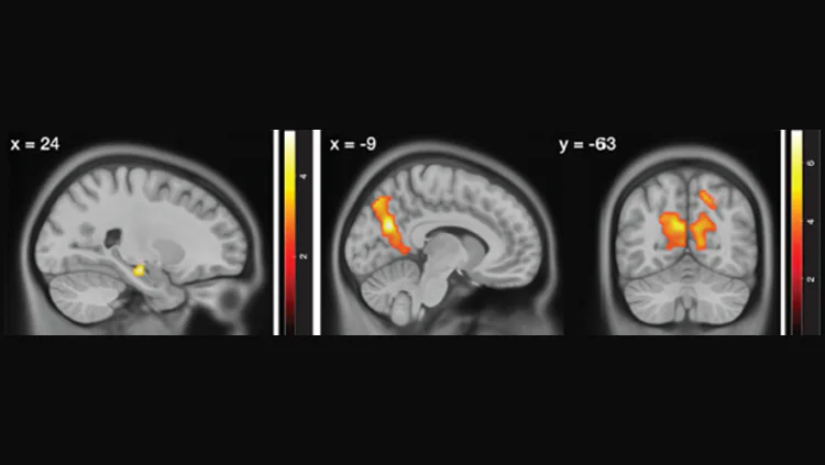 Brain scan findings may lead to new drugs for memory loss