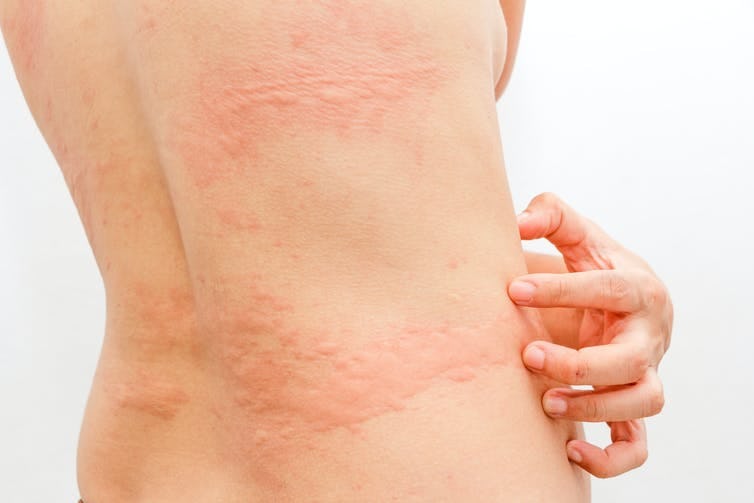 Covid19 skin symptoms 4 unusual changes to look for
