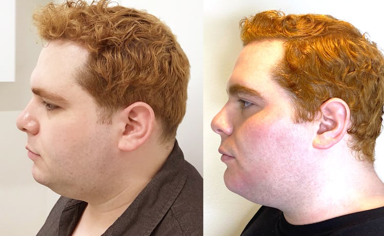 Before and after of TruSculpt