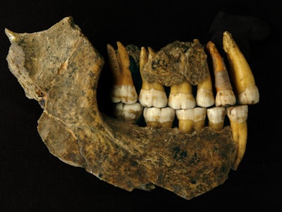 A set of Neanderthal teeth. 