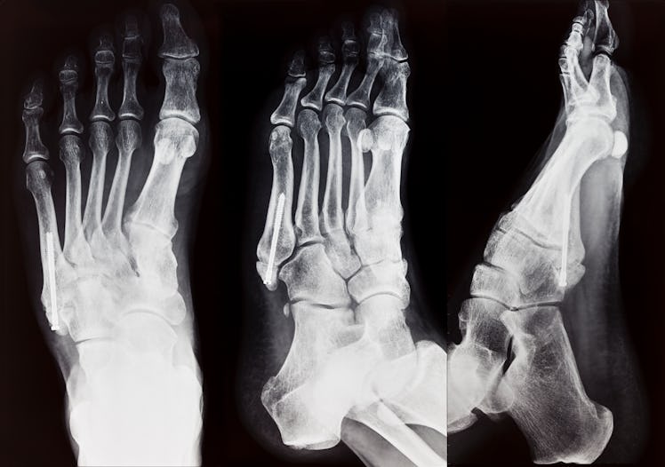 foot, X-ray