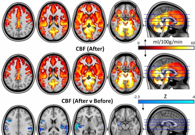 psilocybin brain