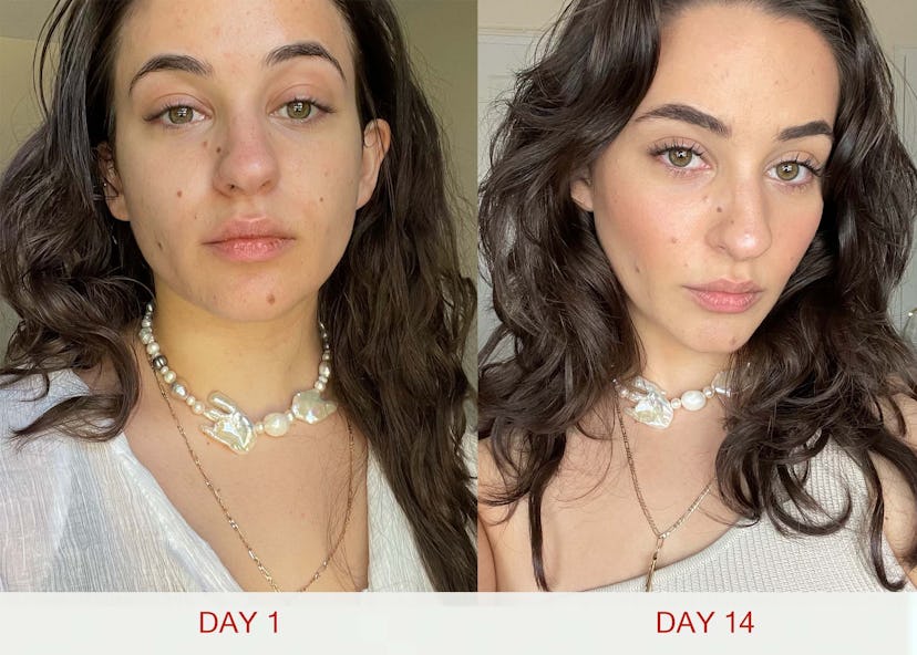 a before and after of Isabella with dry lips on day 1 and Isabella with plump lips on day 14