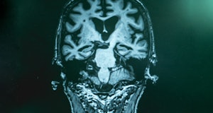 MRI of person with Alzheimer's disease