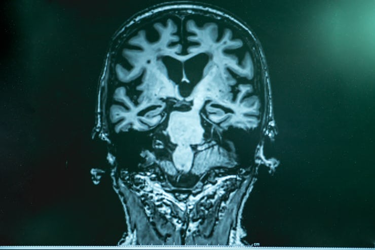MRI of person with Alzheimer's disease
