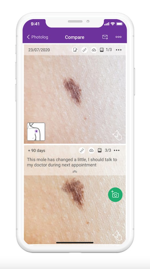Miiskin is a useful app that checks your moles for potential signs of skin cancer — but it's not a r...