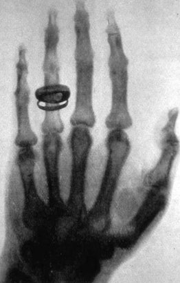 Many of us have received X-rays before, but one of the first people to receive one in history was Al...