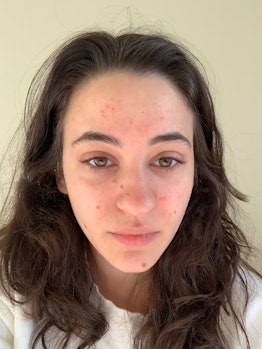 Isabella with acne before Carbon Star