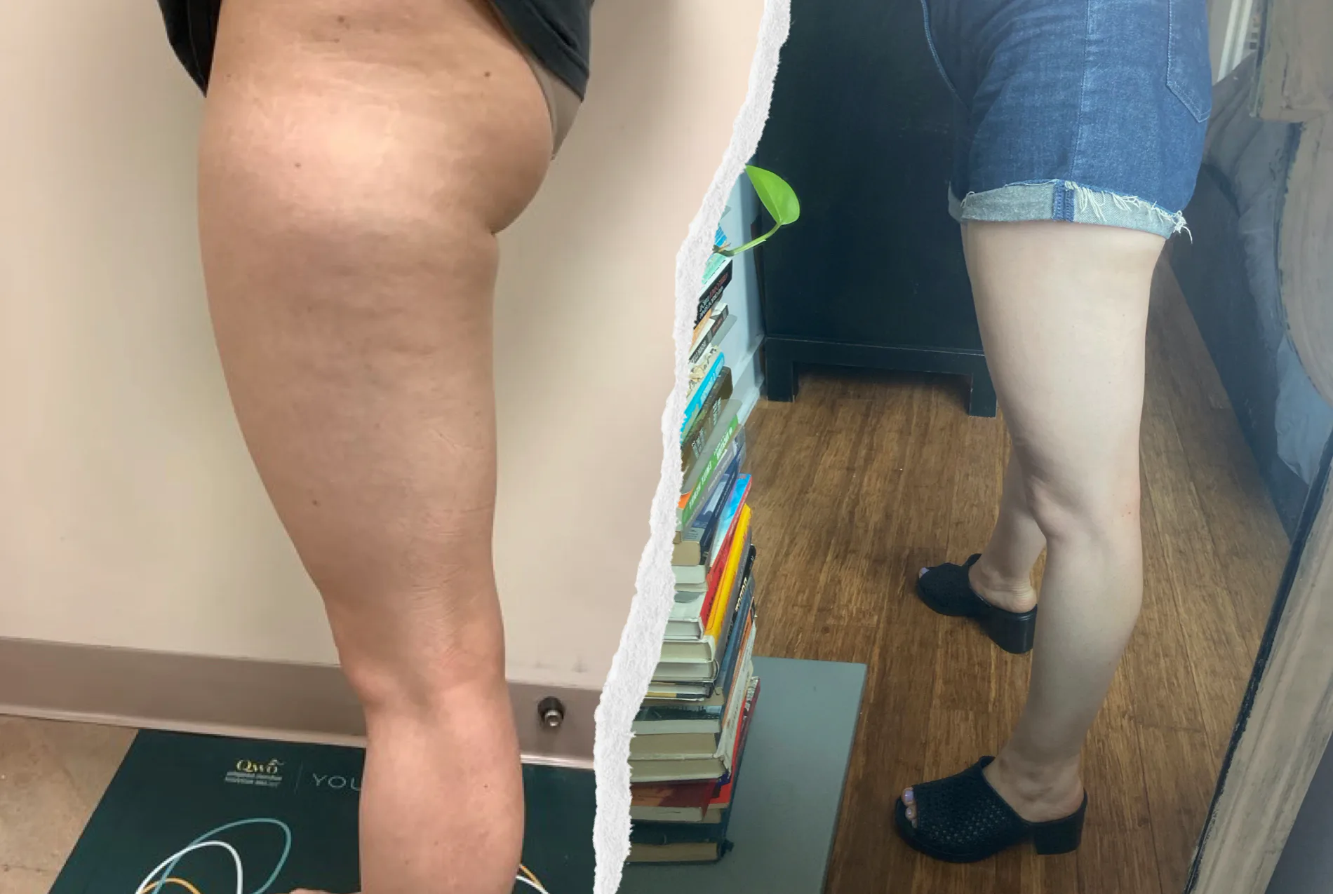 QWO Cellulite Treatment Review: What To Know About The Injectable