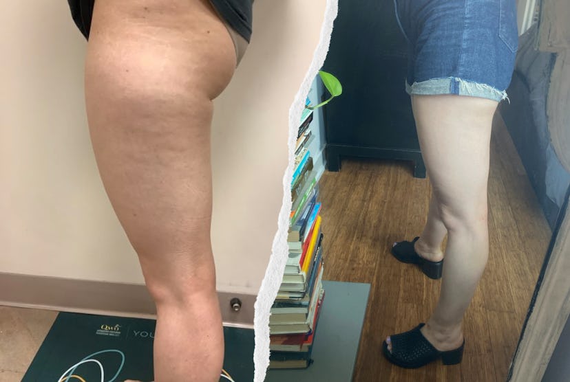 I tried QWO, the first injectable cellulite treatment.