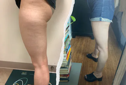 QWO Cellulite Treatment Review: What To Know About The Injectable