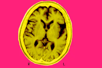 brain scan