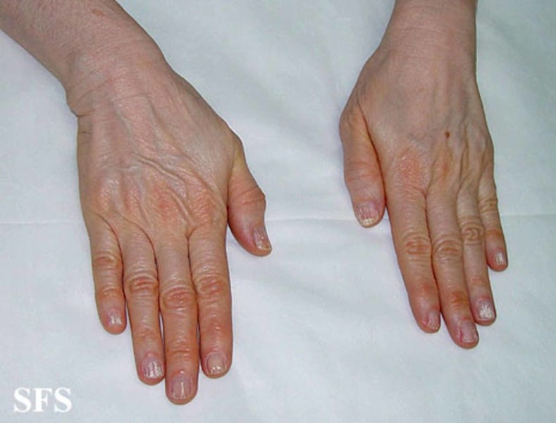 carotenemia example fingers