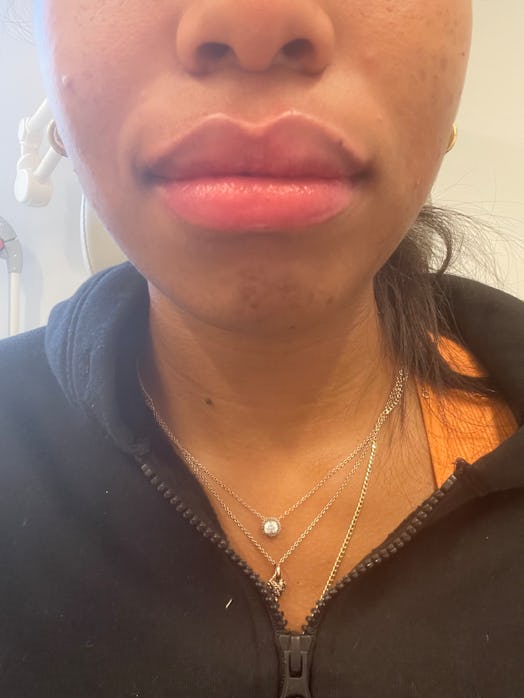 Lips of a woman after getting filled