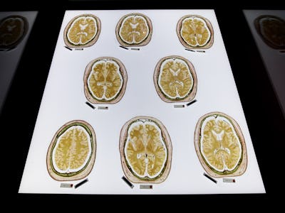 Plastinated slices of the human brain