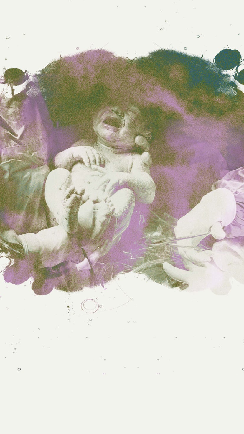 A baby being delivered via C-section