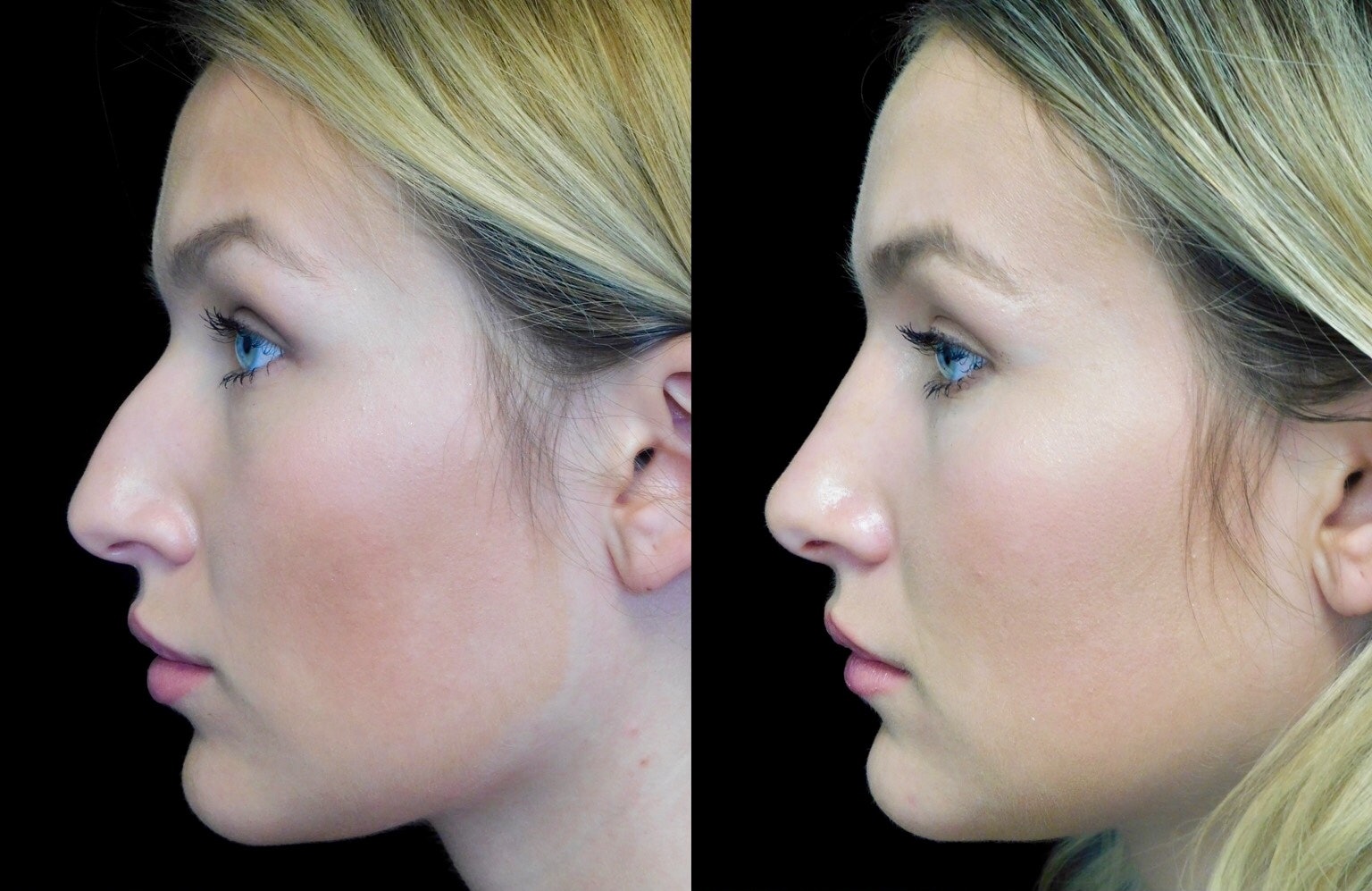 What Is A Closed Rhinoplasty Here s How It Compares To